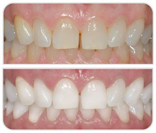 teeth4