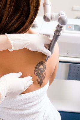 tattoo удаление татуировки